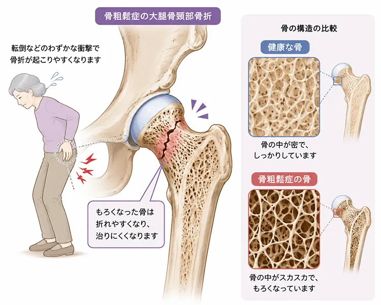 骨粗鬆症のイメージ画像