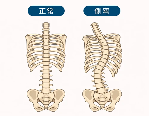 側弯症とは